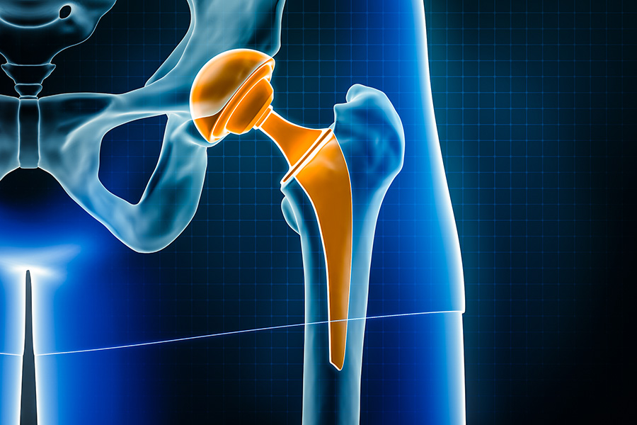 Hip replacement illustration